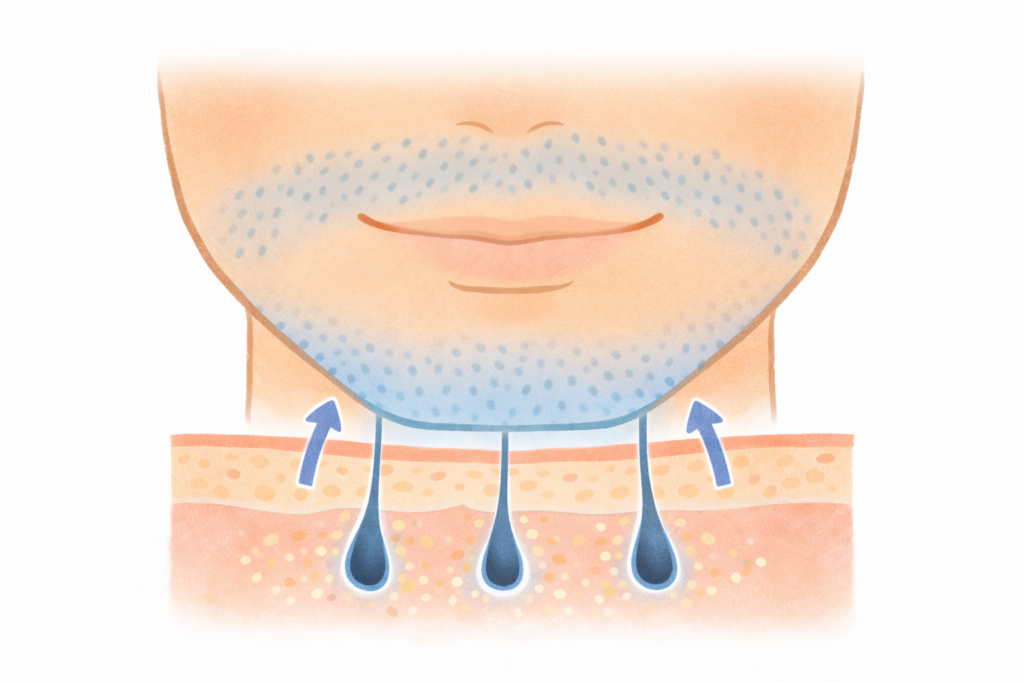 女性の青髭がひどく見える仕組みを毛根の断面で説明したイラスト